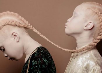 Obaseki Pays Medical Bills Of 3 Albinos