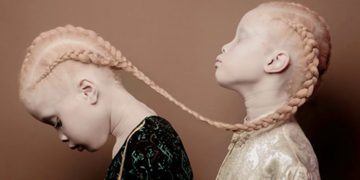 Obaseki Pays Medical Bills Of 3 Albinos