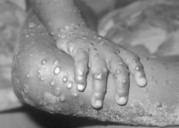 NCDC Confirms 15 Cases Of Monkeypox In Nigeria