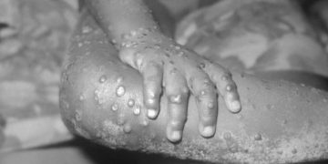 NCDC Confirms 15 Cases Of Monkeypox In Nigeria