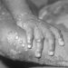 NCDC Confirms 15 Cases Of Monkeypox In Nigeria