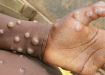 US Tracks Over 200 Persons For Possible Monkeypox Infections