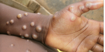 US Tracks Over 200 Persons For Possible Monkeypox Infections