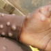 US Tracks Over 200 Persons For Possible Monkeypox Infections