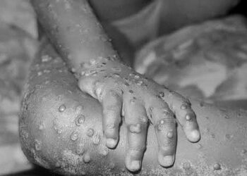 WHO Set To Determine If Mpox Outbreak In Africa Is A Global Emergency
