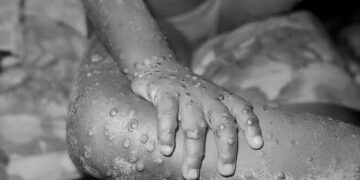 WHO Set To Determine If Mpox Outbreak In Africa Is A Global Emergency