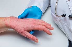 Sweden Reports First Case Of Monkeypox