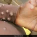 mpox