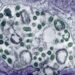 WHO: Ghana Reports Two Suspected Cases Of Marburg Virus