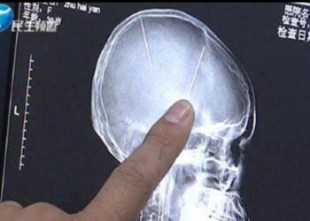 Russia: Woman Who Lived 80 Years With Needle In Brain Gets Freedom