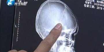 Russia: Woman Who Lived 80 Years With Needle In Brain Gets Freedom