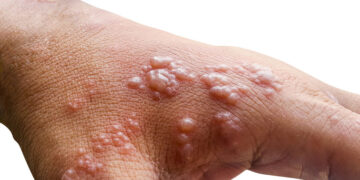 5 Effective Ways To Prevent Monkeypox
