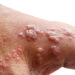 5 Effective Ways To Prevent Monkeypox