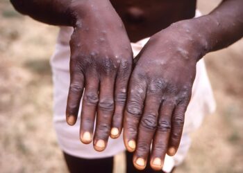 Japan Agrees To Ship Mpox Vaccine To DRC