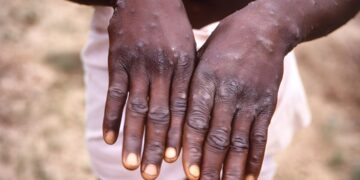 Japan Agrees To Ship Mpox Vaccine To DRC