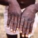 Japan Agrees To Ship Mpox Vaccine To DRC
