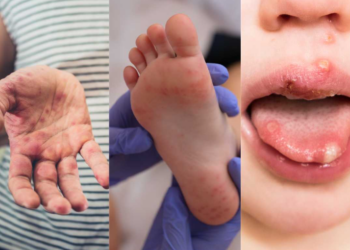 S/Africa: KwaZulu-Natal Province Battles Resurgence Of Hand, Foot, And Mouth Disease