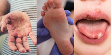 S/Africa: KwaZulu-Natal Province Battles Resurgence Of Hand, Foot, And Mouth Disease